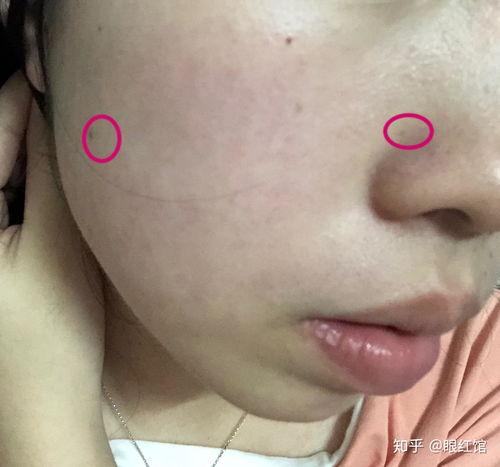 去痣视频过程,跟随视频教程，安全高效祛痣步骤解析