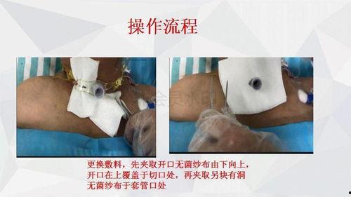 气管切开护理视频,气管切开术后护理要点及操作规范